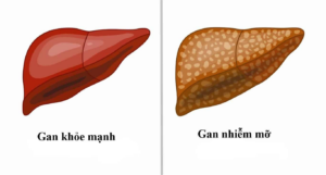 Chế độ ăn cho người gan nhiễm mỡ: Những thực phẩm nên kiêng?