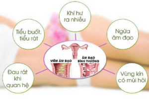 dấu hiệu bị viêm vùng kín